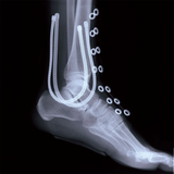 X-ray of Support Brace